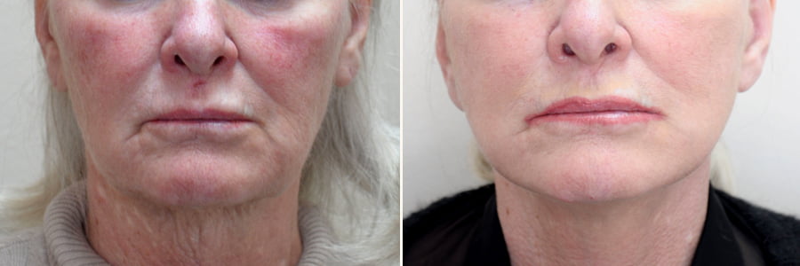 Before-After Picture of Facelift