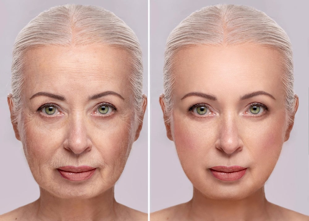 portrait-elderly-lady-after-optimum-mobility-facelift